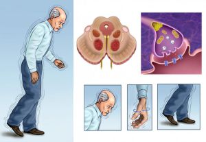 Best Doctor for Parkinson Disease in Bangalore